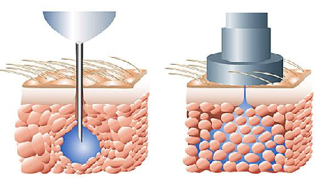 Needle-free injection system; the MS Pulse250